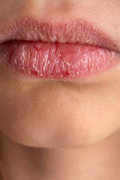 foto che mostra in dettaglio delle labbra screpolate